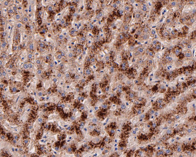 Immunohistochemical analysis of paraffin-embedded human breast carcinoma tissue using anti-ARF5 antibody. The section was pre-treated using heat mediated antigen retrieval with Tris-EDTA buffer (pH 8.0-8.4) for 20 minutes.The tissues were blocked in 5% BSA for 30 minutes at room temperature, washed with ddH2O and PBS, and then probed with the primary antibody (ET7110-46, 1/50) for 30 minutes at room temperature. The detection was performed using an HRP conjugated compact polymer system. DAB was used as the chromogen. Tissues were counterstained with hematoxylin and mounted with DPX.