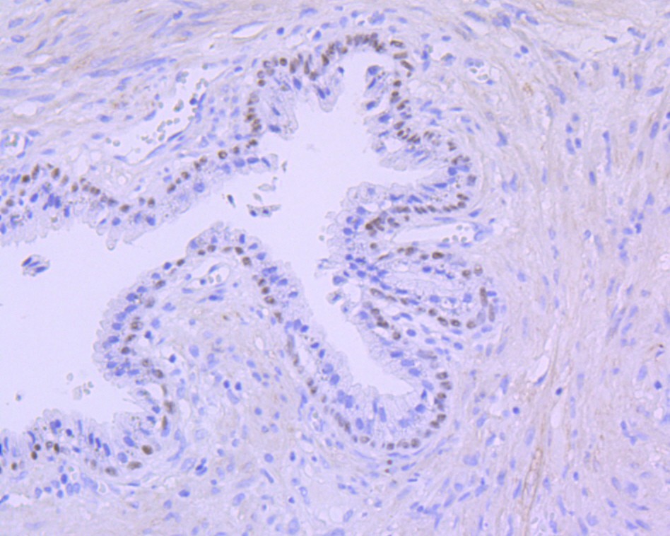 Immunohistochemical analysis of paraffin-embedded human prostate tissue using anti-p63 antibody. The section was pre-treated using heat mediated antigen retrieval with Tris-EDTA buffer (pH 8.0-8.4) for 20 minutes.The tissues were blocked in 5% BSA for 30 minutes at room temperature, washed with ddH2O and PBS, and then probed with the primary antibody (ET7110-47, 1/1000) for 30 minutes at room temperature. The detection was performed using an HRP conjugated compact polymer system. DAB was used as the chromogen. Tissues were counterstained with hematoxylin and mounted with DPX.