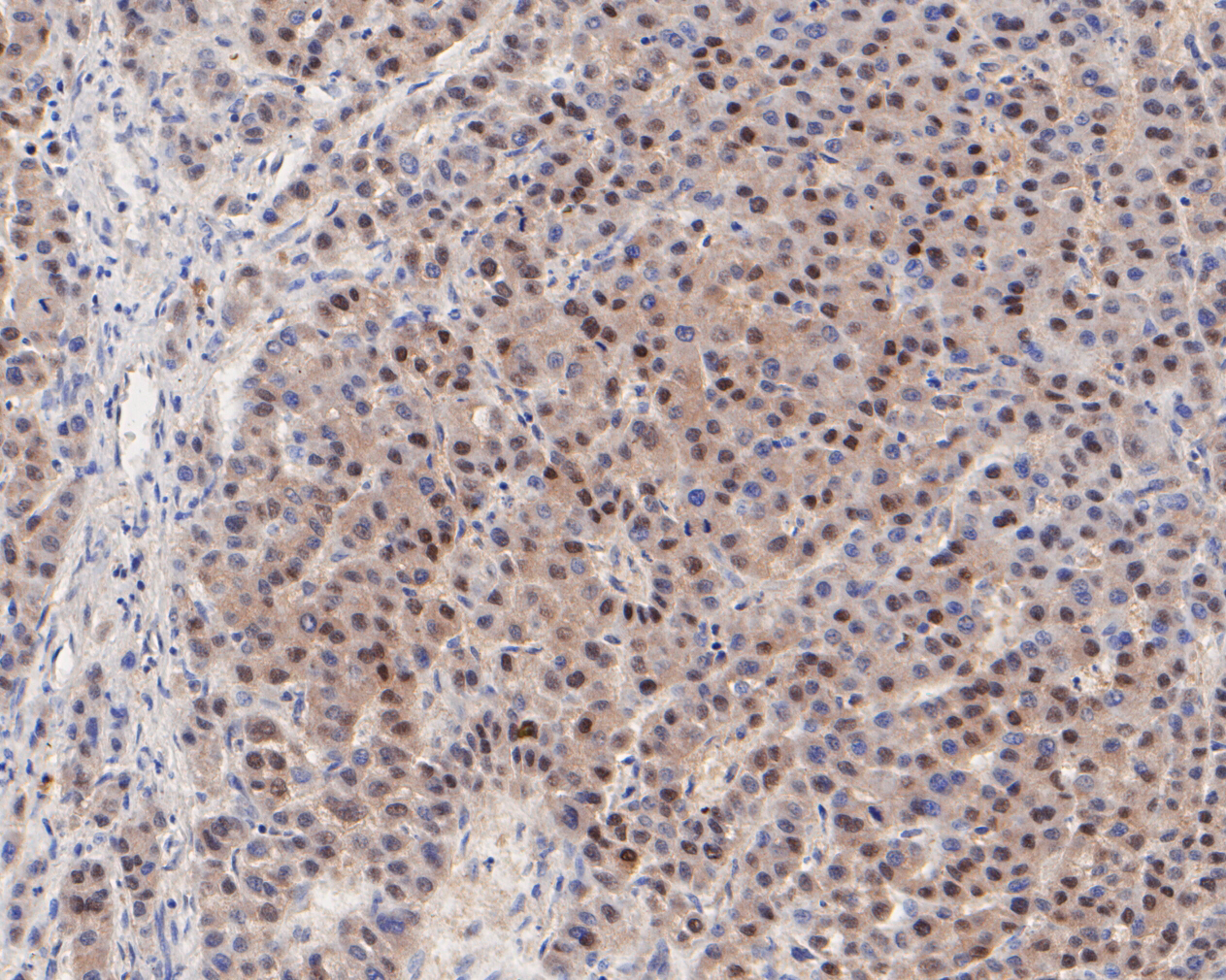 Immunohistochemical analysis of paraffin-embedded human liver carcinoma tissue using anti-MGMT antibody. The section was pre-treated using heat mediated antigen retrieval with sodium citrate buffer (pH 6.0) for 20 minutes. The tissues were blocked in 5% BSA for 30 minutes at room temperature, washed with ddH2O and PBS, and then probed with the primary antibody (ET7110-52, 1/100)  for 30 minutes at room temperature. The detection was performed using an HRP conjugated compact polymer system. DAB was used as the chromogen. Tissues were counterstained with hematoxylin and mounted with DPX.