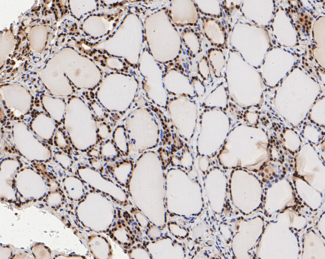 Immunohistochemical analysis of paraffin-embedded human thyroid tissue using anti-MGMT antibody. The section was pre-treated using heat mediated antigen retrieval with sodium citrate buffer (pH 6.0) for 20 minutes. The tissues were blocked in 5% BSA for 30 minutes at room temperature, washed with ddH2O and PBS, and then probed with the primary antibody (ET7110-52, 1/100)  for 30 minutes at room temperature. The detection was performed using an HRP conjugated compact polymer system. DAB was used as the chromogen. Tissues were counterstained with hematoxylin and mounted with DPX.