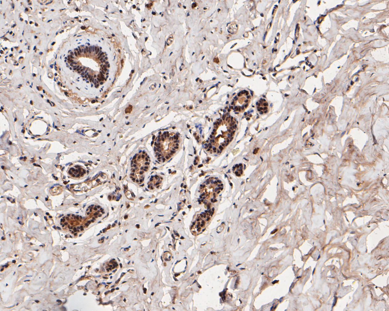 Immunohistochemical analysis of paraffin-embedded human breast tissue using anti-MGMT antibody. The section was pre-treated using heat mediated antigen retrieval with sodium citrate buffer (pH 6.0) for 20 minutes. The tissues were blocked in 5% BSA for 30 minutes at room temperature, washed with ddH2O and PBS, and then probed with the primary antibody (ET7110-52, 1/100)  for 30 minutes at room temperature. The detection was performed using an HRP conjugated compact polymer system. DAB was used as the chromogen. Tissues were counterstained with hematoxylin and mounted with DPX.