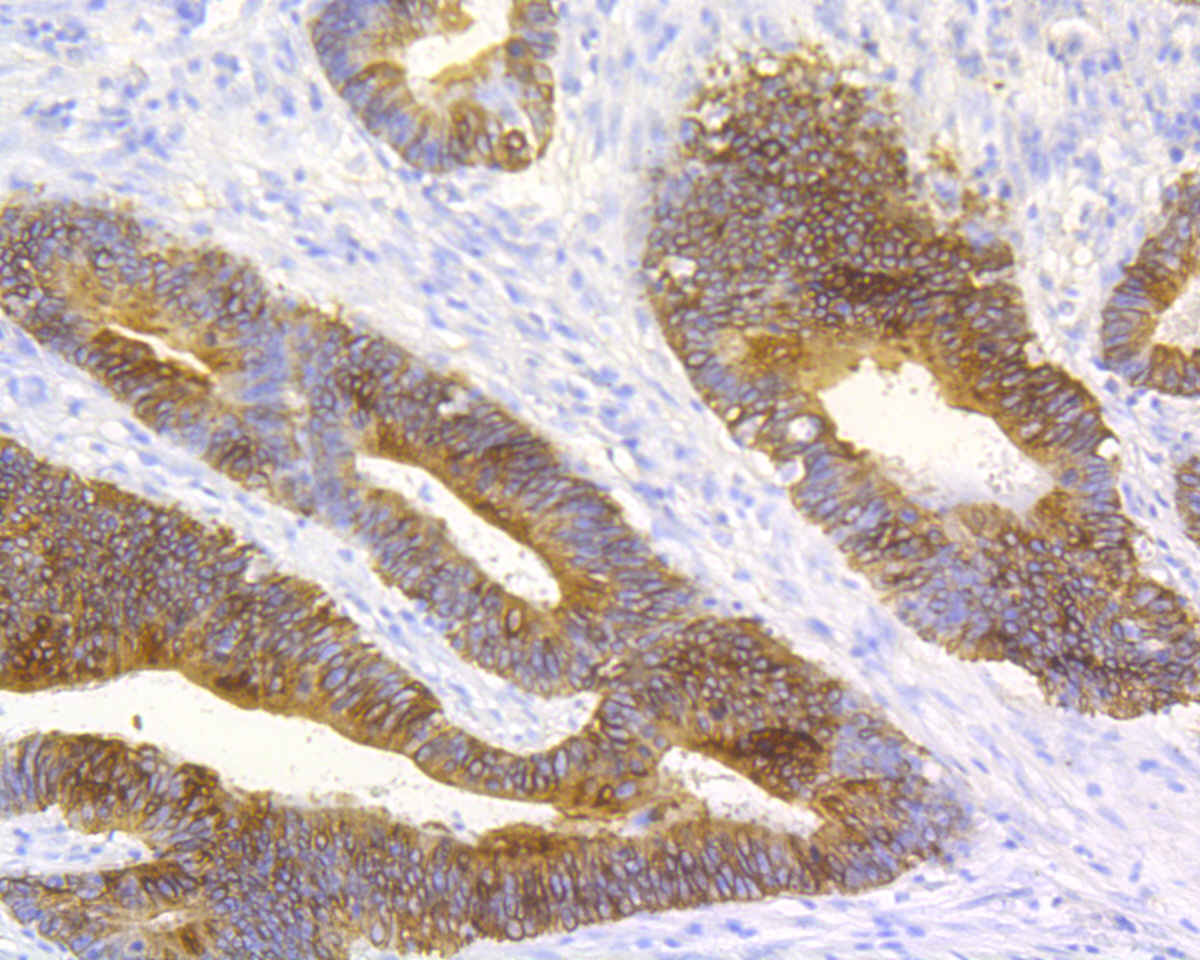 Immunohistochemical analysis of paraffin-embedded human colon carcinoma tissue using anti-Cytokeratin 20 antibody. The section was pre-treated using heat mediated antigen retrieval with Tris-EDTA buffer (pH 8.0-8.4) for 20 minutes.The tissues were blocked in 5% BSA for 30 minutes at room temperature, washed with ddH2O and PBS, and then probed with the primary antibody (ET7110-54, 1/50) for 30 minutes at room temperature. The detection was performed using an HRP conjugated compact polymer system. DAB was used as the chromogen. Tissues were counterstained with hematoxylin and mounted with DPX.