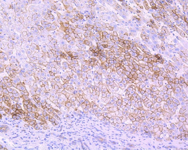 Immunohistochemical analysis of paraffin-embedded human liver tissue using anti-Villin1 antibody. The section was pre-treated using heat mediated antigen retrieval with Tris-EDTA buffer (pH 8.0-8.4) for 20 minutes.The tissues were blocked in 5% BSA for 30 minutes at room temperature, washed with ddH2O and PBS, and then probed with the primary antibody (ET7110-55, 1/50) for 30 minutes at room temperature. The detection was performed using an HRP conjugated compact polymer system. DAB was used as the chromogen. Tissues were counterstained with hematoxylin and mounted with DPX.