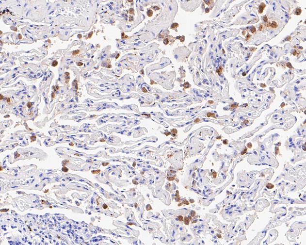Immunohistochemical analysis of paraffin-embedded human lung tissue with Rabbit anti-Cathepsin D antibody (ET7110-58) at 1/200 dilution.<br />
<br />
The section was pre-treated using heat mediated antigen retrieval with Tris-EDTA buffer (pH 8.0-8.4) for 20 minutes. The tissues were blocked in 1% BSA for 20 minutes at room temperature, washed with ddH2O and PBS, and then probed with the primary antibody (ET7110-58) at 1/200 dilution for 0.5 hour at room temperature. The detection was performed using an HRP conjugated compact polymer system. DAB was used as the chromogen. Tissues were counterstained with hematoxylin and mounted with DPX.