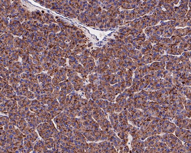 Immunohistochemical analysis of paraffin-embedded human liver carcinoma tissue with Rabbit anti-Cathepsin D antibody (ET7110-58) at 1/50 dilution.<br />
<br />
The section was pre-treated using heat mediated antigen retrieval with Tris-EDTA buffer (pH 8.0-8.4) for 20 minutes. The tissues were blocked in 1% BSA for 20 minutes at room temperature, washed with ddH2O and PBS, and then probed with the primary antibody (ET7110-58) at 1/50 dilution for 0.5 hour at room temperature. The detection was performed using an HRP conjugated compact polymer system. DAB was used as the chromogen. Tissues were counterstained with hematoxylin and mounted with DPX.