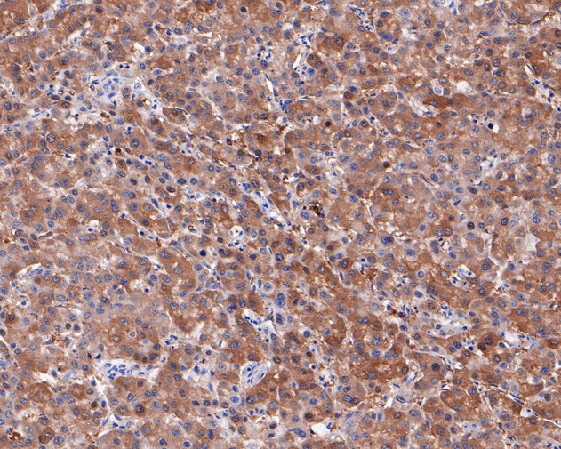 Immunohistochemical analysis of paraffin-embedded human liver carcinoma tissue using anti-Neurocan antibody. The section was pre-treated using heat mediated antigen retrieval with Tris-EDTA buffer (pH 9.0) for 20 minutes.The tissues were blocked in 5% BSA for 30 minutes at room temperature, washed with ddH2O and PBS, and then probed with the primary antibody (ET7110-59, 1/50) for 30 minutes at room temperature. The detection was performed using an HRP conjugated compact polymer system. DAB was used as the chromogen. Tissues were counterstained with hematoxylin and mounted with DPX.