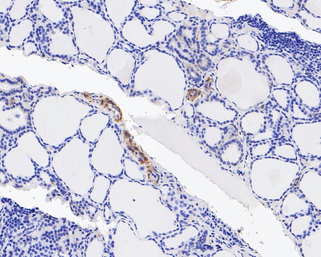 Immunohistochemical analysis of paraffin-embedded human thyroid tissue using anti-Integrin beta 3 antibody. The section was pre-treated using heat mediated antigen retrieval with Tris-EDTA buffer (pH 8.0-8.4) for 20 minutes.The tissues were blocked in 5% BSA for 30 minutes at room temperature, washed with ddH2O and PBS, and then probed with the primary antibody (ET7110-61, 1/100) for 30 minutes at room temperature. The detection was performed using an HRP conjugated compact polymer system. DAB was used as the chromogen. Tissues were counterstained with hematoxylin and mounted with DPX.