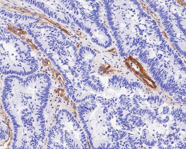 Immunohistochemical analysis of paraffin-embedded human colon carcinoma tissue using anti-Integrin beta 3 antibody. The section was pre-treated using heat mediated antigen retrieval with Tris-EDTA buffer (pH 8.0-8.4) for 20 minutes.The tissues were blocked in 5% BSA for 30 minutes at room temperature, washed with ddH2O and PBS, and then probed with the primary antibody (ET7110-61, 1/100) for 30 minutes at room temperature. The detection was performed using an HRP conjugated compact polymer system. DAB was used as the chromogen. Tissues were counterstained with hematoxylin and mounted with DPX.