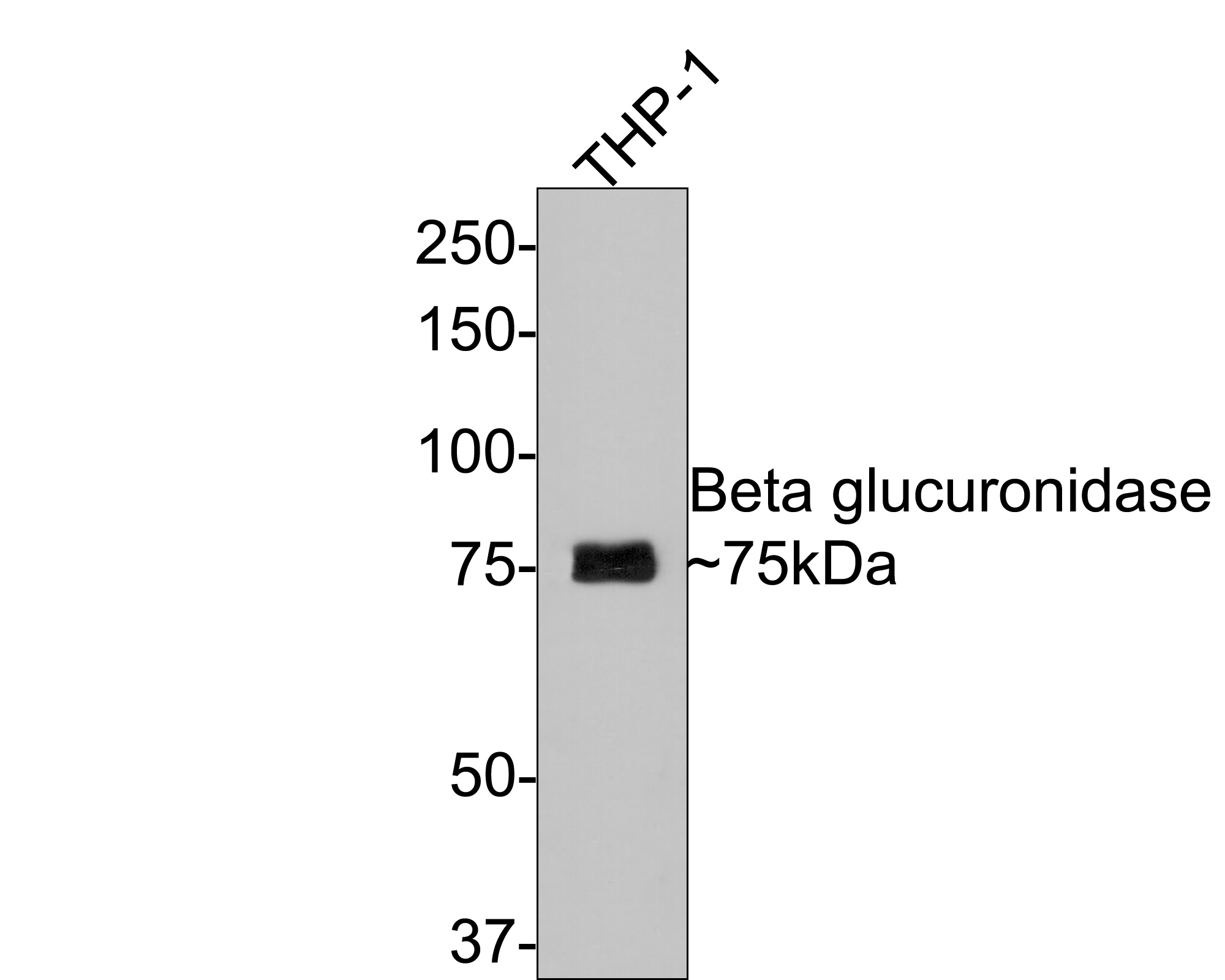 Immunohistochemical analysis of paraffin-embedded human prostate carcinoma tissue using anti-Beta glucuronidase antibody. The section was pre-treated using heat mediated antigen retrieval with Tris-EDTA buffer (pH 8.0-8.4) for 20 minutes.The tissues were blocked in 5% BSA for 30 minutes at room temperature, washed with ddH2O and PBS, and then probed with the primary antibody (ET7110-66, 1/200) for 30 minutes at room temperature. The detection was performed using an HRP conjugated compact polymer system. DAB was used as the chromogen. Tissues were counterstained with hematoxylin and mounted with DPX.