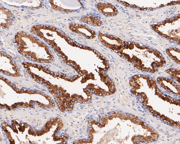 Immunohistochemical analysis of paraffin-embedded human prostate carcinoma tissue with Rabbit anti-Beta glucuronidase antibody (ET7110-66) at 1/200 dilution.<br />
<br />
The section was pre-treated using heat mediated antigen retrieval with Tris-EDTA buffer (pH 8.0-8.4) for 20 minutes. The tissues were blocked in 1% BSA for 20 minutes at room temperature, washed with ddH2O and PBS, and then probed with the primary antibody (ET7110-66) at 1/200 dilution for 1 hour at room temperature. The detection was performed using an HRP conjugated compact polymer system. DAB was used as the chromogen. Tissues were counterstained with hematoxylin and mounted with DPX.