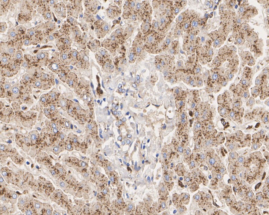 Immunohistochemical analysis of paraffin-embedded human liver tissue with Rabbit anti-GAA antibody (ET7110-77) at 1/50 dilution.<br />
<br />
The section was pre-treated using heat mediated antigen retrieval with Tris-EDTA buffer (pH 9.0) for 20 minutes. The tissues were blocked in 1% BSA for 20 minutes at room temperature, washed with ddH2O and PBS, and then probed with the primary antibody (ET7110-77) at 1/50 dilution for 0.5 hour at room temperature. The detection was performed using an HRP conjugated compact polymer system. DAB was used as the chromogen. Tissues were counterstained with hematoxylin and mounted with DPX.