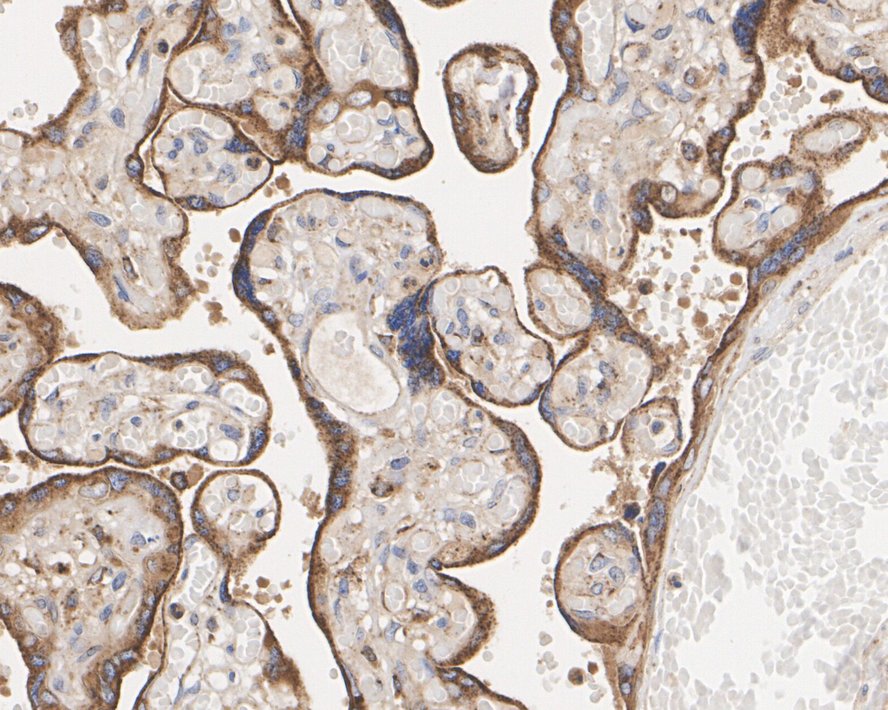Immunohistochemical analysis of paraffin-embedded human liver carcinoma tissue with Rabbit anti-GAA antibody (ET7110-77) at 1/50 dilution.<br />
<br />
The section was pre-treated using heat mediated antigen retrieval with Tris-EDTA buffer (pH 9.0) for 20 minutes. The tissues were blocked in 1% BSA for 20 minutes at room temperature, washed with ddH2O and PBS, and then probed with the primary antibody (ET7110-77) at 1/50 dilution for 0.5 hour at room temperature. The detection was performed using an HRP conjugated compact polymer system. DAB was used as the chromogen. Tissues were counterstained with hematoxylin and mounted with DPX.