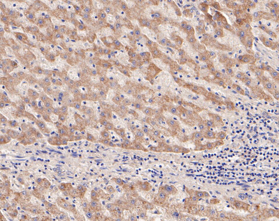 Immunohistochemical analysis of paraffin-embedded human liver tissue with Rabbit anti-DPYD antibody (ET7110-83) at 1/200 dilution.<br />
<br />
The section was pre-treated using heat mediated antigen retrieval with Tris-EDTA buffer (pH 8.0-8.4) for 20 minutes. The tissues were blocked in 1% BSA for 20 minutes at room temperature, washed with ddH2O and PBS, and then probed with the primary antibody (ET7110-83) at 1/200 dilution for 0.5 hour at room temperature. The detection was performed using an HRP conjugated compact polymer system. DAB was used as the chromogen. Tissues were counterstained with hematoxylin and mounted with DPX.