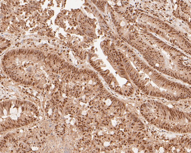 Immunohistochemical analysis of paraffin-embedded human colon carcinoma tissue using anti-NFYA antibody. The section was pre-treated using heat mediated antigen retrieval with sodium citrate buffer (pH 6.0) for 20 minutes. The tissues were blocked in 5% BSA for 30 minutes at room temperature, washed with ddH2O and PBS, and then probed with the primary antibody (ET7110-85, 1/100)  for 30 minutes at room temperature. The detection was performed using an HRP conjugated compact polymer system. DAB was used as the chromogen. Tissues were counterstained with hematoxylin and mounted with DPX.