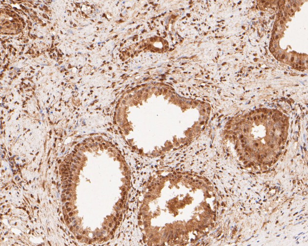 Immunohistochemical analysis of paraffin-embedded human prostate carcinoma tissue using anti-NFYA antibody. The section was pre-treated using heat mediated antigen retrieval with sodium citrate buffer (pH 6.0) for 20 minutes. The tissues were blocked in 5% BSA for 30 minutes at room temperature, washed with ddH2O and PBS, and then probed with the primary antibody (ET7110-85, 1/100)  for 30 minutes at room temperature. The detection was performed using an HRP conjugated compact polymer system. DAB was used as the chromogen. Tissues were counterstained with hematoxylin and mounted with DPX.