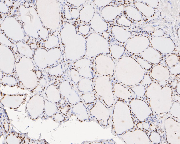 Immunohistochemical analysis of paraffin-embedded human thyroid <br />
 tissue with Rabbit anti-Tat-SF1 antibody (ET7110-87) at 1/100 dilution.<br />
<br />
The section was pre-treated using heat mediated antigen retrieval with Tris-EDTA buffer (pH 6.0) for 20 minutes. The tissues were blocked in 1% BSA for 20 minutes at room temperature, washed with ddH2O and PBS, and then probed with the primary antibody (ET7110-87) at 1/100 dilution for 0.5 hour at room temperature. The detection was performed using an HRP conjugated compact polymer system. DAB was used as the chromogen. Tissues were counterstained with hematoxylin and mounted with DPX.