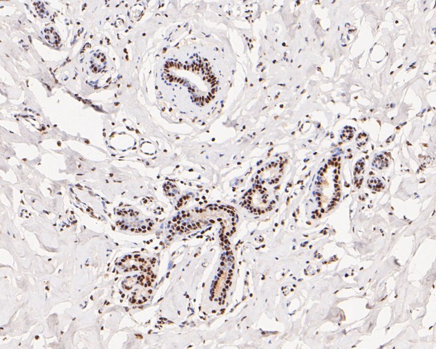 Immunohistochemical analysis of paraffin-embedded human breast tissue with Rabbit anti-Tat-SF1 antibody (ET7110-87) at 1/100 dilution.<br />
<br />
The section was pre-treated using heat mediated antigen retrieval with Tris-EDTA buffer (pH 6.0) for 20 minutes. The tissues were blocked in 1% BSA for 20 minutes at room temperature, washed with ddH2O and PBS, and then probed with the primary antibody (ET7110-87) at 1/100 dilution for 0.5 hour at room temperature. The detection was performed using an HRP conjugated compact polymer system. DAB was used as the chromogen. Tissues were counterstained with hematoxylin and mounted with DPX.