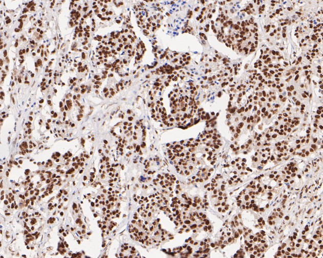 Immunohistochemical analysis of paraffin-embedded human stomach carcinoma tissue with Rabbit anti-Tat-SF1 antibody (ET7110-87) at 1/100 dilution.<br />
<br />
The section was pre-treated using heat mediated antigen retrieval with Tris-EDTA buffer (pH 6.0) for 20 minutes. The tissues were blocked in 1% BSA for 20 minutes at room temperature, washed with ddH2O and PBS, and then probed with the primary antibody (ET7110-87) at 1/100 dilution for 0.5 hour at room temperature. The detection was performed using an HRP conjugated compact polymer system. DAB was used as the chromogen. Tissues were counterstained with hematoxylin and mounted with DPX.
