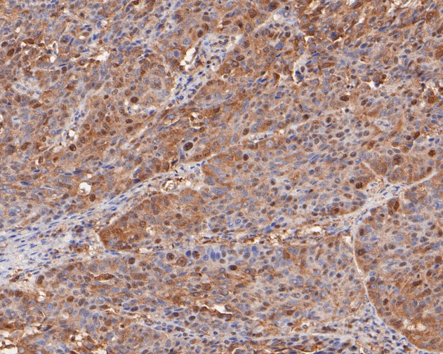 Immunohistochemical analysis of paraffin-embedded human lung carcinoma tissue using anti-BAT3 antibody. The section was pre-treated using heat mediated antigen retrieval with sodium citrate buffer (pH 6.0) for 20 minutes. The tissues were blocked in 5% BSA for 30 minutes at room temperature, washed with ddH2O and PBS, and then probed with the primary antibody (ET7110-88, 1/50)  for 30 minutes at room temperature. The detection was performed using an HRP conjugated compact polymer system. DAB was used as the chromogen. Tissues were counterstained with hematoxylin and mounted with DPX.