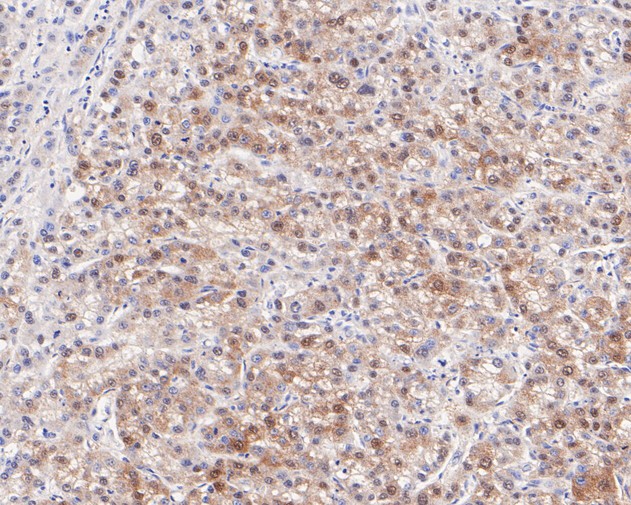 Immunohistochemical analysis of paraffin-embedded  human liver carcinoma tissue with Rabbit anti-PEX19 antibody (ET7110-89) at 1/100 dilution.<br />
<br />
The section was pre-treated using heat mediated antigen retrieval with Tris-EDTA buffer (pH 8.0-8.4)) for 20 minutes. The tissues were blocked in 1% BSA for 20 minutes at room temperature, washed with ddH2O and PBS, and then probed with the primary antibody (ET7110-89) at 1/100 dilution for 0.5 hour at room temperature. The detection was performed using an HRP conjugated compact polymer system. DAB was used as the chromogen. Tissues were counterstained with hematoxylin and mounted with DPX.