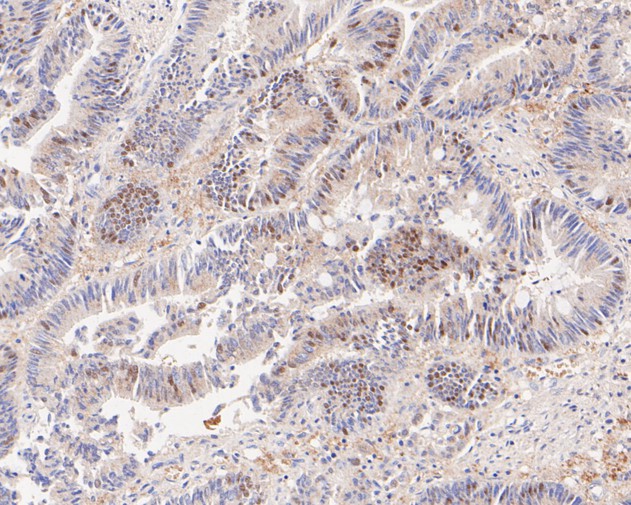 Immunohistochemical analysis of paraffin-embedded  human colon carcinoma tissue with Rabbit anti-PEX19 antibody (ET7110-89) at 1/100 dilution.<br />
<br />
The section was pre-treated using heat mediated antigen retrieval with Tris-EDTA buffer (pH 8.0-8.4)) for 20 minutes. The tissues were blocked in 1% BSA for 20 minutes at room temperature, washed with ddH2O and PBS, and then probed with the primary antibody (ET7110-89) at 1/100 dilution for 0.5 hour at room temperature. The detection was performed using an HRP conjugated compact polymer system. DAB was used as the chromogen. Tissues were counterstained with hematoxylin and mounted with DPX.