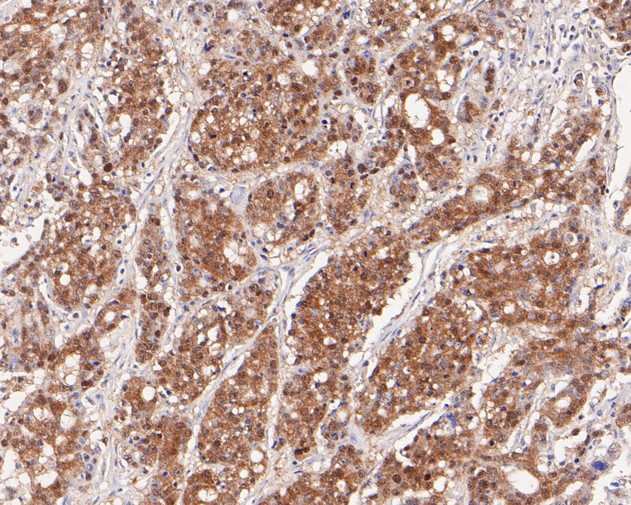 Immunohistochemical analysis of paraffin-embedded  human stomach carcinoma tissue with Rabbit anti-PEX19 antibody (ET7110-89) at 1/100 dilution.<br />
<br />
The section was pre-treated using heat mediated antigen retrieval with Tris-EDTA buffer (pH 8.0-8.4)) for 20 minutes. The tissues were blocked in 1% BSA for 20 minutes at room temperature, washed with ddH2O and PBS, and then probed with the primary antibody (ET7110-89) at 1/100 dilution for 0.5 hour at room temperature. The detection was performed using an HRP conjugated compact polymer system. DAB was used as the chromogen. Tissues were counterstained with hematoxylin and mounted with DPX.