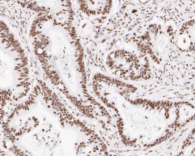 Immunohistochemical analysis of paraffin-embedded human colon carcinoma tissue using anti-XPD antibody. The section was pre-treated using heat mediated antigen retrieval with sodium citrate buffer (pH 6.0) for 20 minutes. The tissues were blocked in 5% BSA for 30 minutes at room temperature, washed with ddH2O and PBS, and then probed with the primary antibody (ET7110-93, 1/200)  for 30 minutes at room temperature. The detection was performed using an HRP conjugated compact polymer system. DAB was used as the chromogen. Tissues were counterstained with hematoxylin and mounted with DPX.