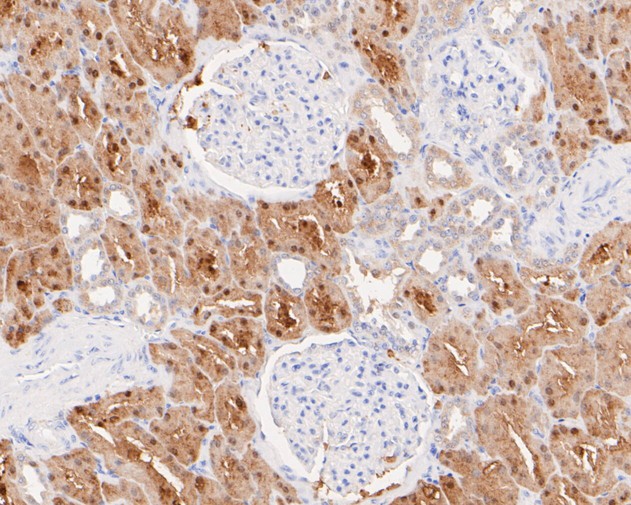 Immunohistochemical analysis of paraffin-embedded human kidney tissue with Rabbit anti-Glycerol Kinase antibody (ET7110-96) at 1/200 dilution.<br />
<br />
The section was pre-treated using heat mediated antigen retrieval with Tris-EDTA buffer(pH 8.0-8.4))for 20 minutes. The tissues were blocked in 1% BSA for 20 minutes at room temperature, washed with ddH2O and PBS, and then probed with the primary antibody (ET7110-96) at 1/200 dilution for 0.5 hour at room temperature. The detection was performed using an HRP conjugated compact polymer system. DAB was used as the chromogen. Tissues were counterstained with hematoxylin and mounted with DPX.