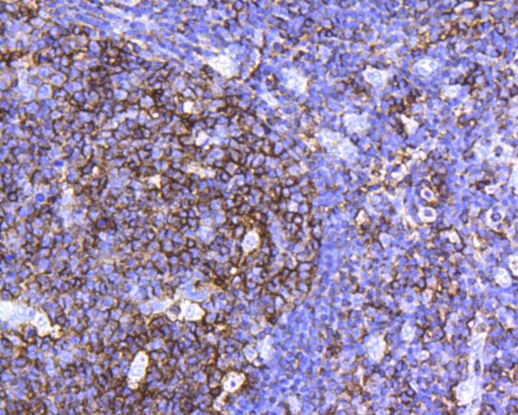 Immunohistochemical analysis of paraffin-embedded human colon cancer tissue with Rabbit anti-CD45 antibody (ET7111-03) at 1/200 dilution.<br />
<br />
The section was pre-treated using heat mediated antigen retrieval with Tris-EDTA buffer(pH 8.0-8.4))for 20 minutes. The tissues were blocked in 1% BSA for 20 minutes at room temperature, washed with ddH2O and PBS, and then probed with the primary antibody (ET7111-03) at 1/200 dilution for 0.5 hour at room temperature. The detection was performed using an HRP conjugated compact polymer system. DAB was used as the chromogen. Tissues were counterstained with hematoxylin and mounted with DPX.