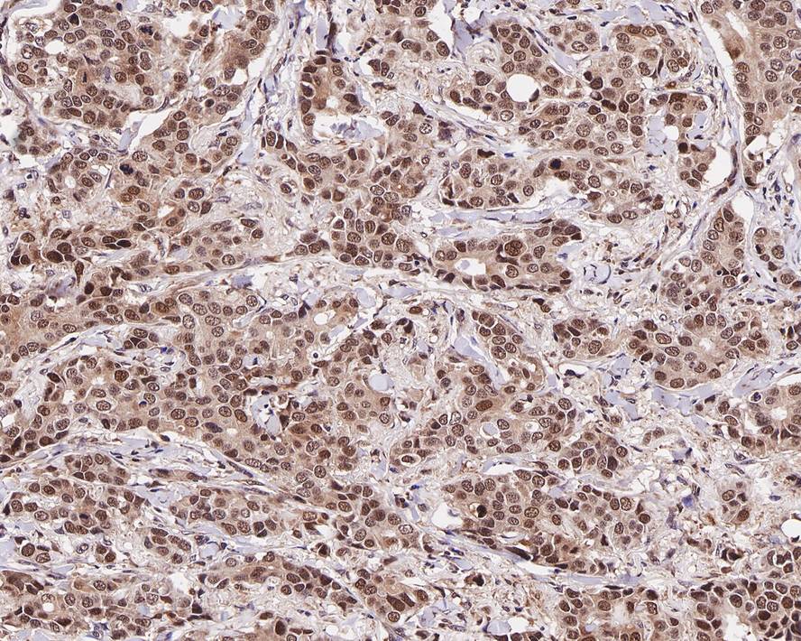 Immunohistochemical analysis of paraffin-embedded human breast carcinoma tissue with Mouse anti-Cyclin E2 antibody (M0407-15) at 1/200 dilution.<br />
<br />
The section was pre-treated using heat mediated antigen retrieval with sodium citrate buffer (pH 6.0) for 2 minutes. The tissues were blocked in 1% BSA for 20 minutes at room temperature, washed with ddH2O and PBS, and then probed with the primary antibody (M0407-15) at 1/200 dilution for 1 hour at room temperature. The detection was performed using an HRP conjugated compact polymer system. DAB was used as the chromogen. Tissues were counterstained with hematoxylin and mounted with DPX.