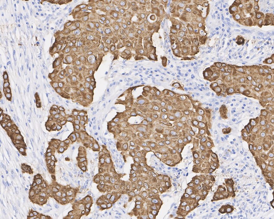 Immunohistochemical analysis of paraffin-embedded human breast cancer tissue with Mouse anti-Cytokeratin 18 antibody (M0407-19) at 1/2,000 dilution.<br />
<br />
The section was pre-treated using heat mediated antigen retrieval with Tris-EDTA buffer (pH 9.0) for 20 minutes. The tissues were blocked in 1% BSA for 20 minutes at room temperature, washed with ddH2O and PBS, and then probed with the primary antibody (M0407-19) at 1/2,000 dilution for 1 hour at room temperature. The detection was performed using an HRP conjugated compact polymer system. DAB was used as the chromogen. Tissues were counterstained with hematoxylin and mounted with DPX.