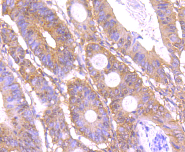 Immunohistochemical analysis of paraffin-embedded human colon cancer tissue using anti-C12orf51 antibody. Counter stained with hematoxylin.