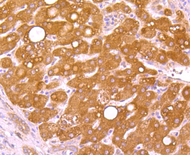Immunohistochemical analysis of paraffin-embedded human liver cancer tissue using anti-WSCD2 antibody. Counter stained with hematoxylin.