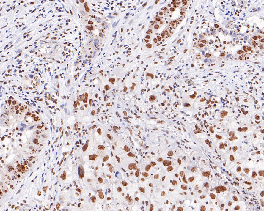 Immunohistochemical analysis of paraffin-embedded human lung squamous cell carcinoma tissue with Mouse anti-PGBD5 antibody (M1012-1) at 1/400 dilution.<br />
<br />
The section was pre-treated using heat mediated antigen retrieval with sodium citrate buffer (pH 6.0) for 2 minutes. The tissues were blocked in 1% BSA for 20 minutes at room temperature, washed with ddH2O and PBS, and then probed with the primary antibody (M1012-1) at 1/400 dilution for 1 hour at room temperature. The detection was performed using an HRP conjugated compact polymer system. DAB was used as the chromogen. Tissues were counterstained with hematoxylin and mounted with DPX.
