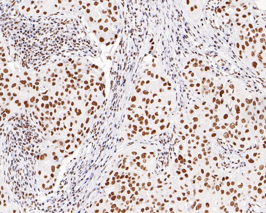 Immunohistochemical analysis of paraffin-embedded human breast carcinoma tissue with Mouse anti-DNA-PKcs/PRKDC antibody (M1204-6) at 1/500 dilution.<br />
<br />
The section was pre-treated using heat mediated antigen retrieval with sodium citrate buffer (pH 6.0) for 2 minutes. The tissues were blocked in 1% BSA for 20 minutes at room temperature, washed with ddH2O and PBS, and then probed with the primary antibody (M1204-6) at 1/500 dilution for 1 hour at room temperature. The detection was performed using an HRP conjugated compact polymer system. DAB was used as the chromogen. Tissues were counterstained with hematoxylin and mounted with DPX.