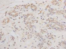Immunohistochemical analysis of paraffin-embedded human breast carcinoma tissue using anti-BCL-2 antibody. Counter stained with hematoxylin.