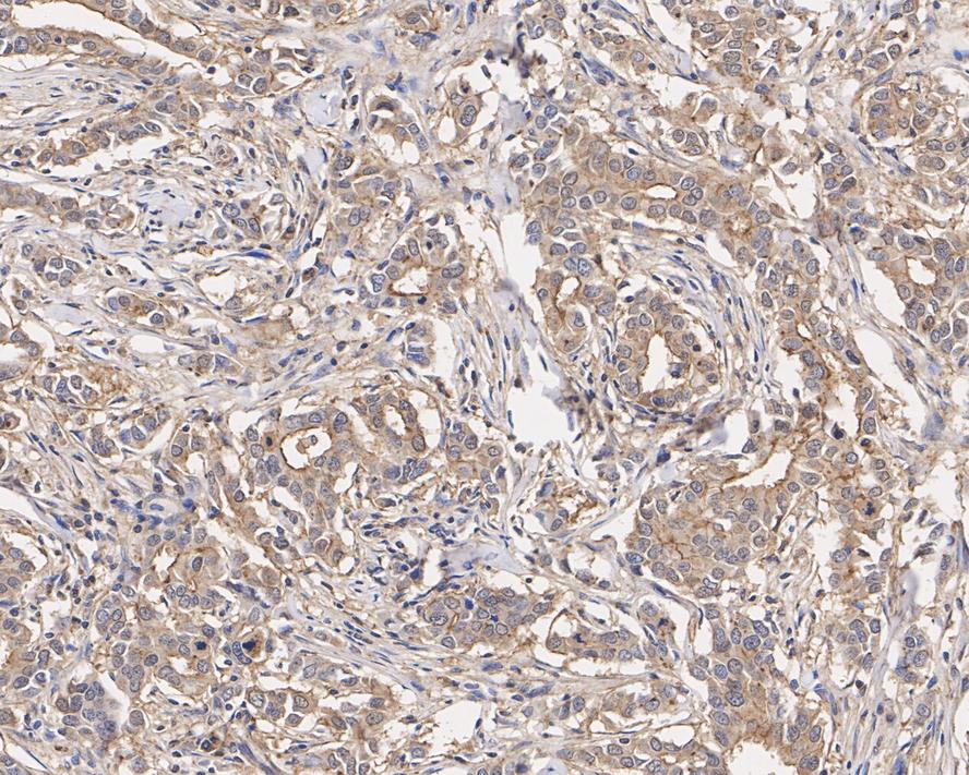 Immunohistochemical analysis of paraffin-embedded human breast cancer tissue with Mouse anti-KIAA0100 antibody (M1210-6) at 1/2,000 dilution.<br />
<br />
The section was pre-treated using heat mediated antigen retrieval with Tris-EDTA buffer (pH 9.0) for 20 minutes. The tissues were blocked in 1% BSA for 20 minutes at room temperature, washed with ddH2O and PBS, and then probed with the primary antibody (M1210-6) at 1/2,000 dilution for 1 hour at room temperature. The detection was performed using an HRP conjugated compact polymer system. DAB was used as the chromogen. Tissues were counterstained with hematoxylin and mounted with DPX.