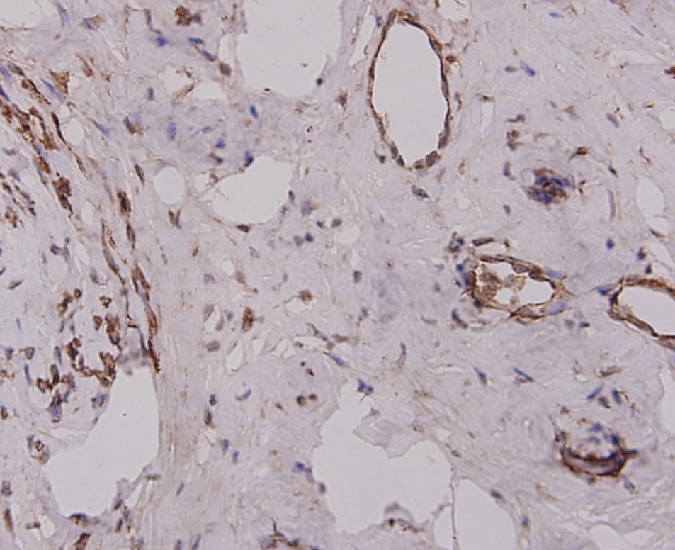 Immunohistochemical analysis of paraffin-embedded human cervix tissue using anti-Desmin antibody. The section was pre-treated using heat mediated antigen retrieval with Tris-EDTA buffer (pH 8.0-8.4) for 20 minutes.The tissues were blocked in 5% BSA for 30 minutes at room temperature, washed with ddH2O and PBS, and then probed with the antibody (M1501-10) at 1/100 dilution, for 30 minutes at room temperature and detected using an HRP conjugated compact polymer system. DAB was used as the chrogen. Counter stained with hematoxylin and mounted with DPX.
