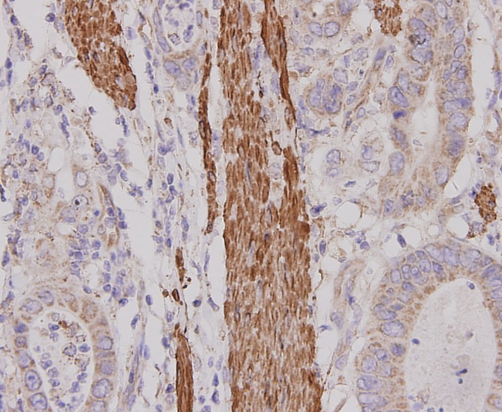 Immunohistochemical analysis of paraffin-embedded human stomach cancer tissue using anti-Desmin antibody. The section was pre-treated using heat mediated antigen retrieval with Tris-EDTA buffer (pH 8.0-8.4) for 20 minutes.The tissues were blocked in 5% BSA for 30 minutes at room temperature, washed with ddH2O and PBS, and then probed with the antibody (M1501-10) at 1/100 dilution, for 30 minutes at room temperature and detected using an HRP conjugated compact polymer system. DAB was used as the chrogen. Counter stained with hematoxylin and mounted with DPX.