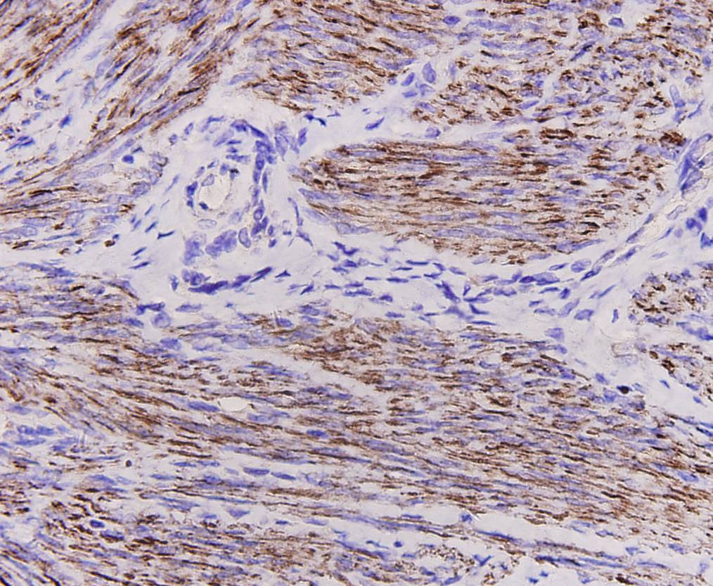 Immunohistochemical analysis of paraffin-embedded human uterus tissue using anti-Desmin antibody. The section was pre-treated using heat mediated antigen retrieval with Tris-EDTA buffer (pH 8.0-8.4) for 20 minutes.The tissues were blocked in 5% BSA for 30 minutes at room temperature, washed with ddH2O and PBS, and then probed with the antibody (M1501-10) at 1/100 dilution, for 30 minutes at room temperature and detected using an HRP conjugated compact polymer system. DAB was used as the chrogen. Counter stained with hematoxylin and mounted with DPX.