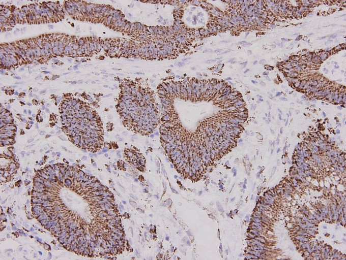 Immunohistochemical analysis of paraffin-embedded human colon carcinoma tissue using anti- ALDH2 mouse mAb.