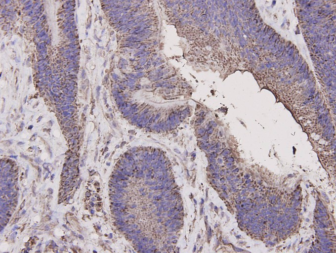 Immunohistochemical analysis of paraffin-embedded human colon carcinoma tissue using anti-Caspase-1 antibody. The section was pre-treated using heat mediated antigen retrieval with Tris-EDTA buffer (pH 8.0-8.4) for 20 minutes.The tissues were blocked in 5% BSA for 30 minutes at room temperature, washed with ddH2O and PBS, and then probed with the primary antibody (M1505-2, 1/200) for 30 minutes at room temperature. The detection was performed using an HRP conjugated compact polymer system. DAB was used as the chromogen. Tissues were counterstained with hematoxylin and mounted with DPX.
