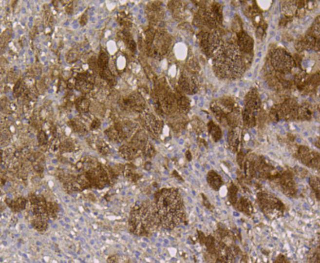 Immunohistochemical analysis of paraffin- embedded human lung cancer tissue using anti-ALDH2 Mouse mAb.