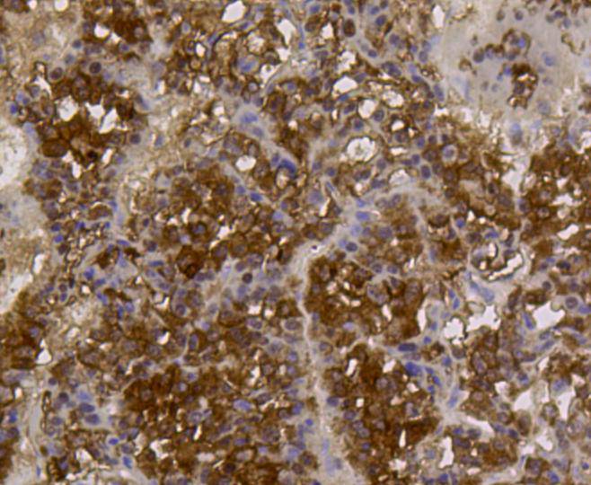 Immunohistochemical analysis of paraffin- embedded human liver cancer tissue using anti-ALDH2 Mouse mAb.