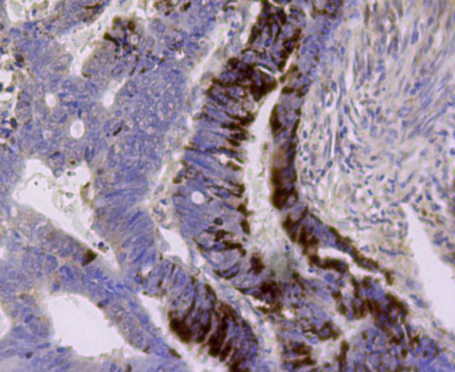 Immunohistochemical analysis of paraffin- embedded human colon cancer tissue using anti-ALDH2 Mouse mAb.