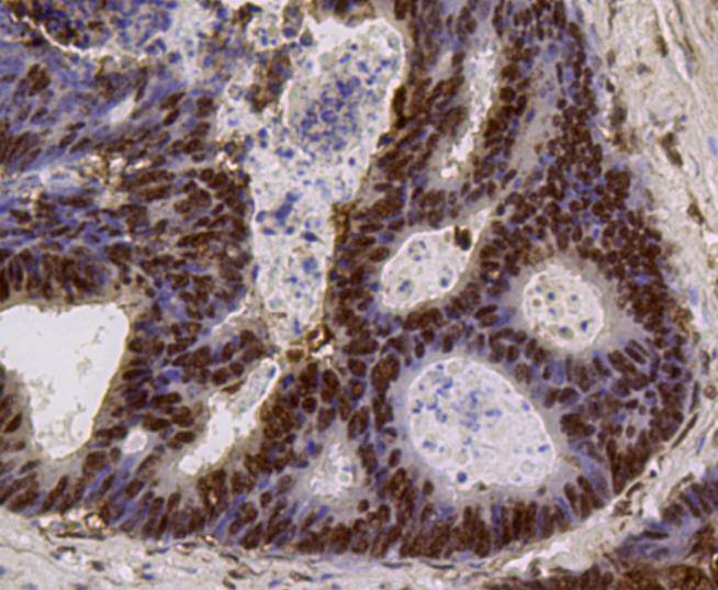 Immunohistochemical analysis of paraffin-embedded human colon cancer tissue using anti-PI3-kinase p85 subunit alpha Mouse mAb.