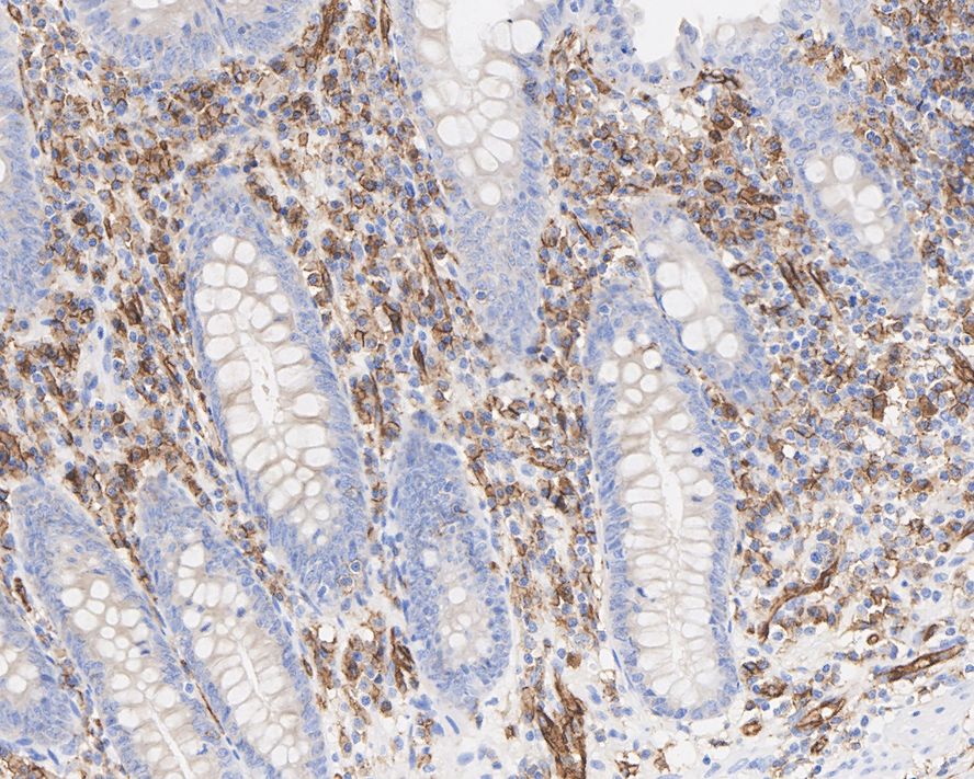 Immunohistochemical analysis of paraffin-embedded human liver tissue with Mouse anti-CD31 antibody (M1511-8) at 1/2,000 dilution.<br />
<br />
The section was pre-treated using heat mediated antigen retrieval with Tris-EDTA buffer (pH 9.0) for 20 minutes. The tissues were blocked in 1% BSA for 20 minutes at room temperature, washed with ddH2O and PBS, and then probed with the primary antibody (M1511-8) at 1/2,000 dilution for 1 hour at room temperature. The detection was performed using an HRP conjugated compact polymer system. DAB was used as the chromogen. Tissues were counterstained with hematoxylin and mounted with DPX.