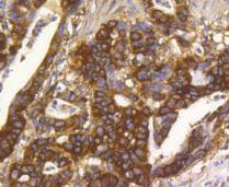 Immunohistochemical analysis of paraffin- embedded human gastric carcinoma tissue using anti-Hsp90 alpha Mouse mAb.