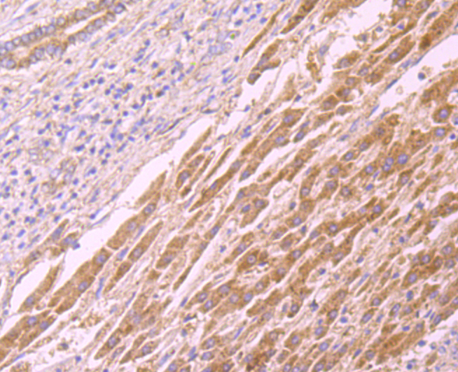 Immunohistochemical analysis of paraffin-embedded human liver cancer tissue using anti-CD137 antibody. Counter stained with hematoxylin.