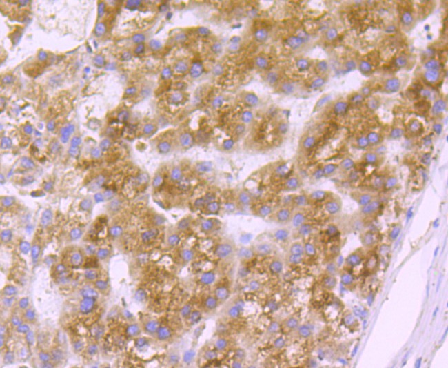 Immunohistochemical analysis of paraffin-embedded human liver cancer tissue using anti-GRP94 antibody. Counter stained with hematoxylin.